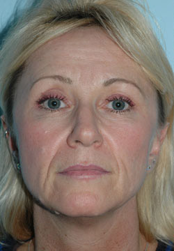 Decydujemy się na botox